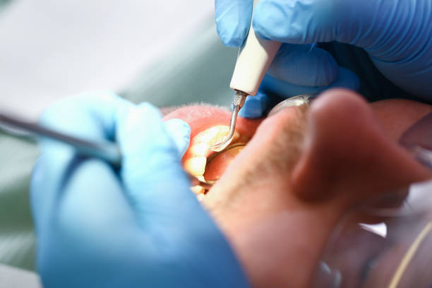 Best Emergency Wisdom Teeth Removal in Temple, TX